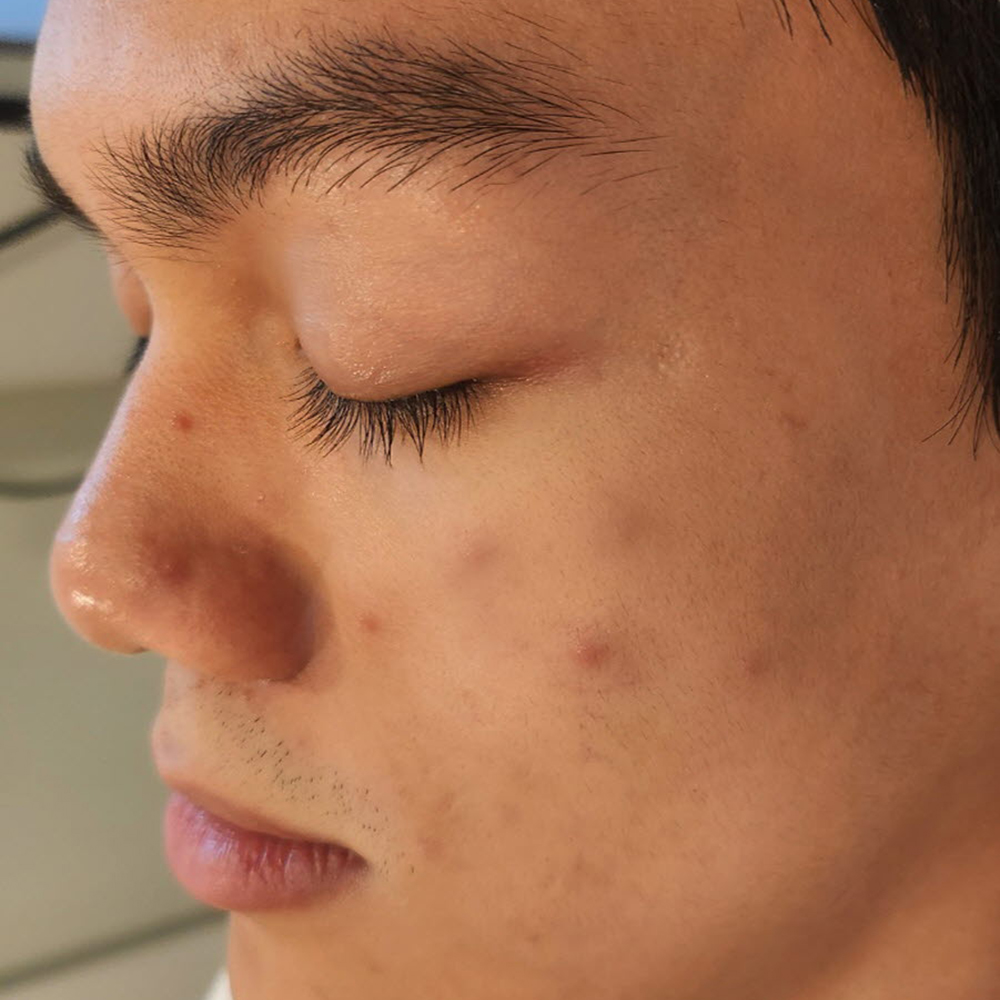 여드름 Before