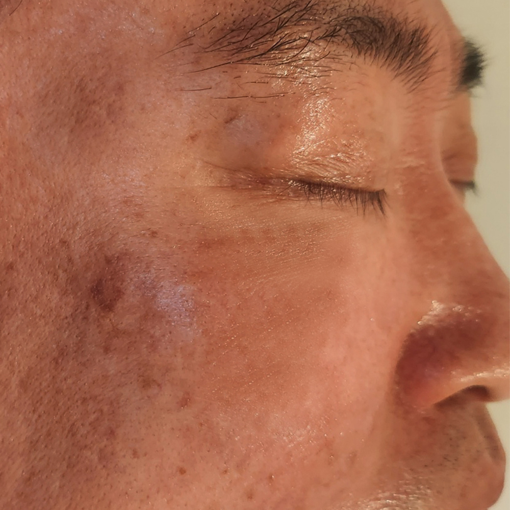 색소침착개선 Before