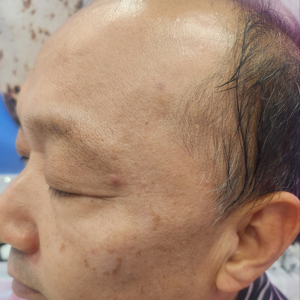 색소침착개선 Before