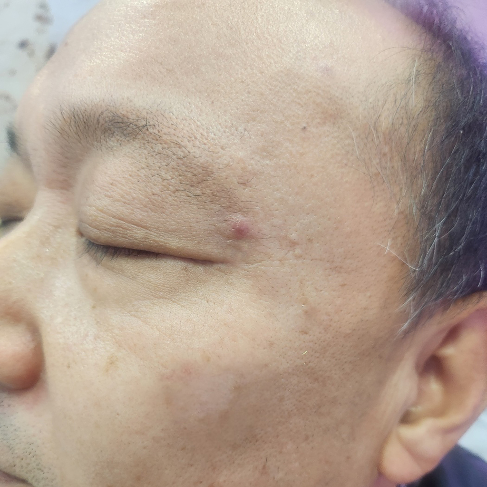 색소침착개선 After