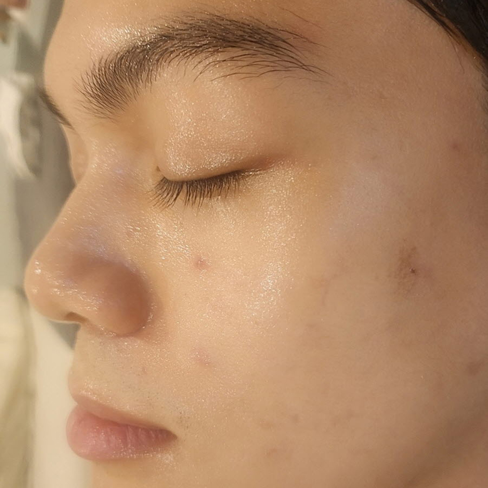 여드름 After