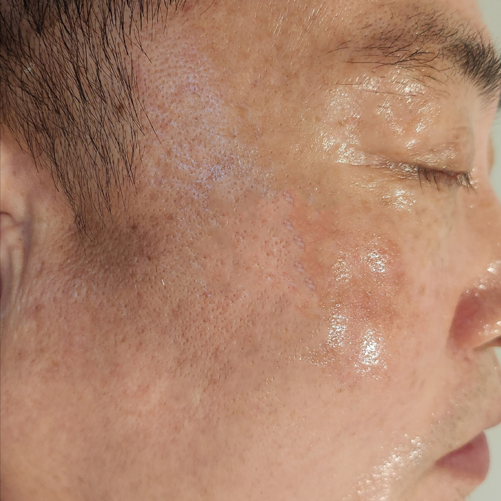 색소침착개선 After